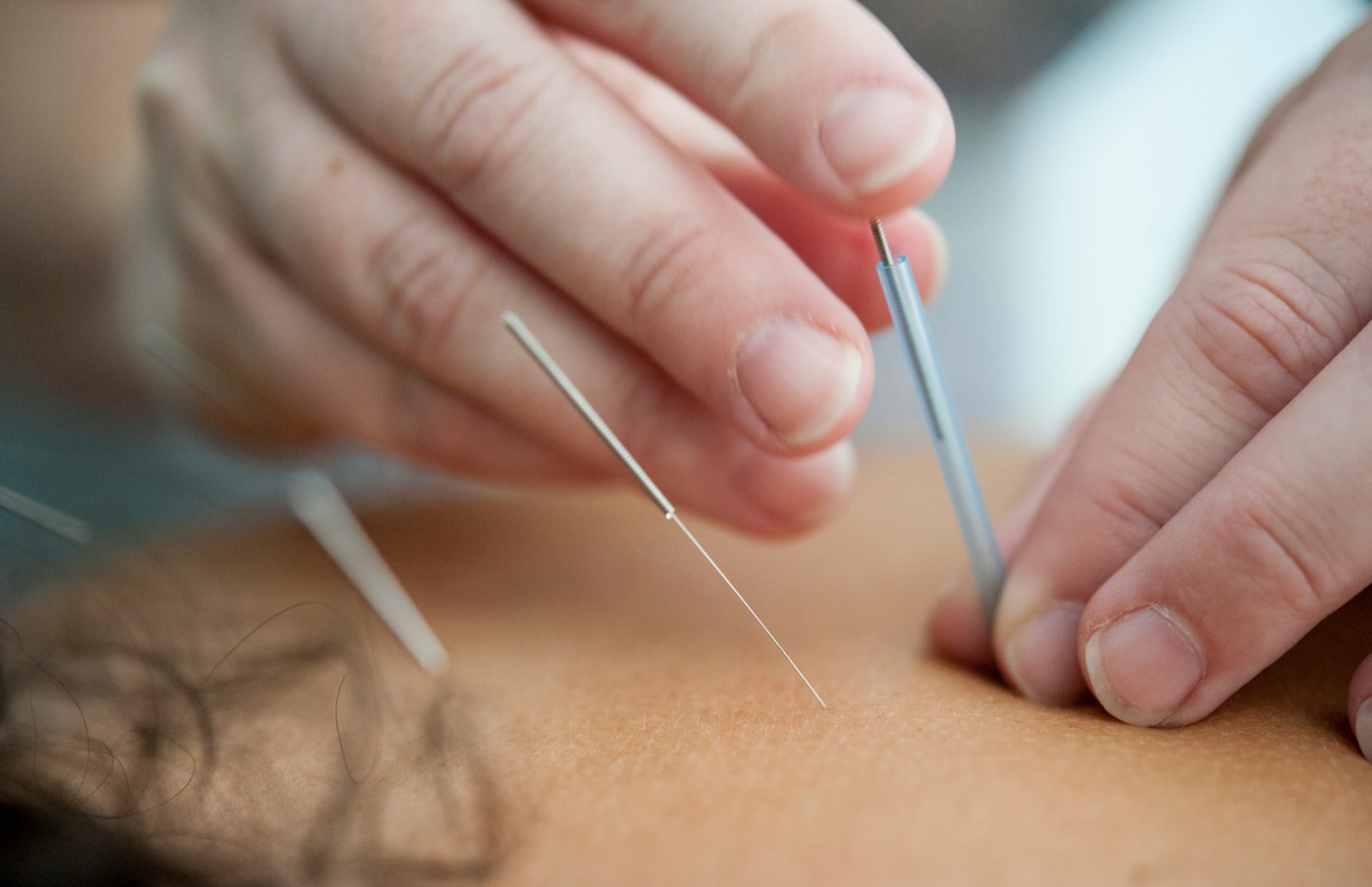 Acupuncture needles being placed by a practitioner